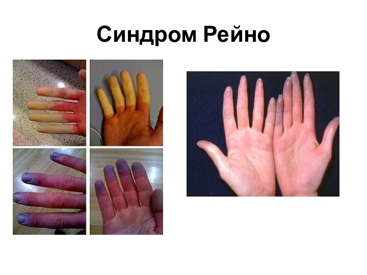 Синдром Рейно