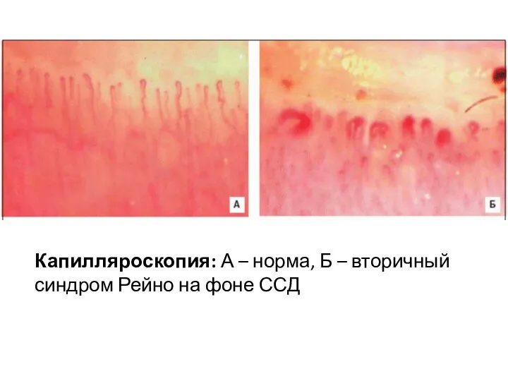Капилляроскопия: А – норма, Б – вторичный синдром Рейно на фоне ССД