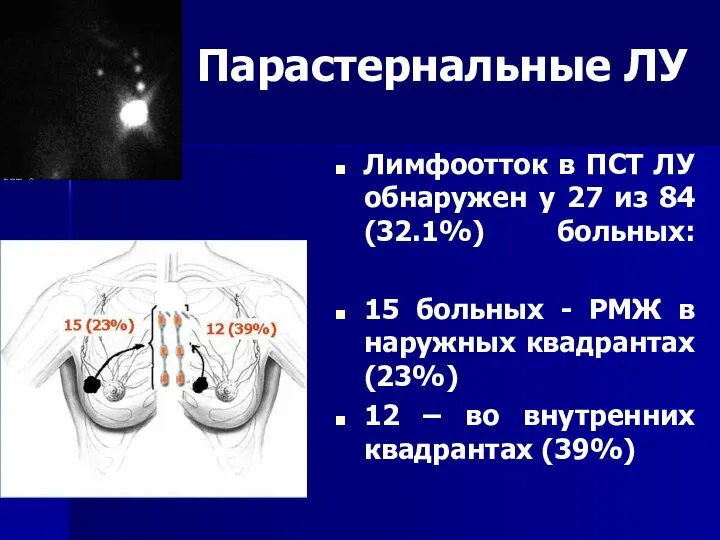 Парастернальные ЛУ Лимфоотток в ПСТ ЛУ обнаружен у 27 из 84 (32.1%)