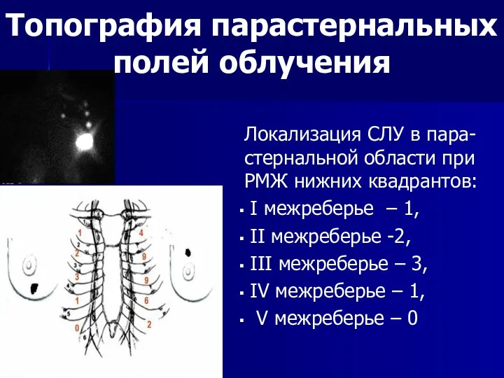 Локализация СЛУ в пара-стернальной области при РМЖ нижних квадрантов: I межреберье –