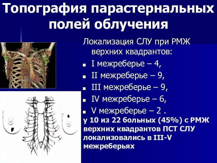 у 10 из 22 больных (45%) с РМЖ верхних квадрантов ПСТ СЛУ