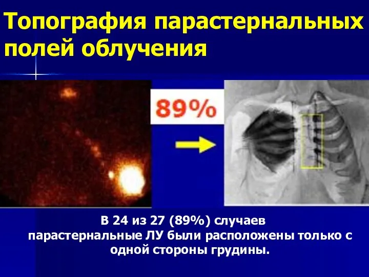 Топография парастернальных полей облучения В 24 из 27 (89%) случаев парастернальные ЛУ