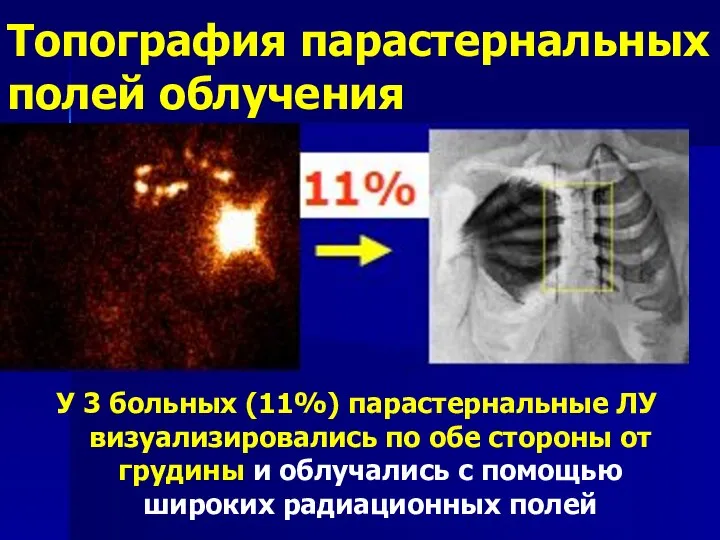 У 3 больных (11%) парастернальные ЛУ визуализировались по обе стороны от грудины