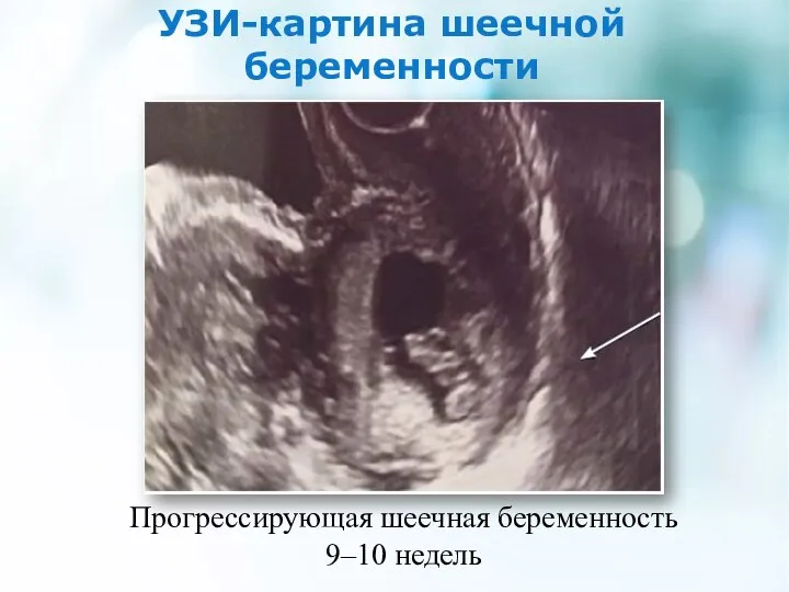 УЗИ-картина шеечной беременности Прогрессирующая шеечная беременность 9–10 недель