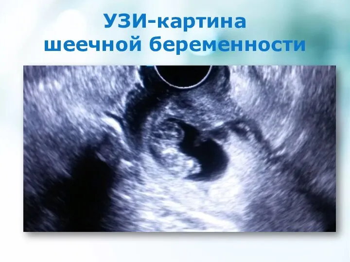 УЗИ-картина шеечной беременности