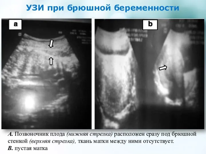 УЗИ при брюшной беременности А. Позвоночник плода (нижняя стрелка) расположен сразу под