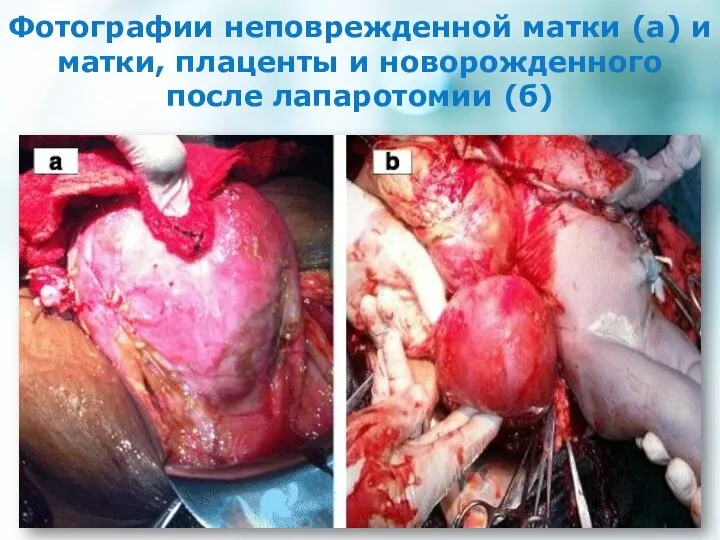 Фотографии неповрежденной матки (а) и матки, плаценты и новорожденного после лапаротомии (б)