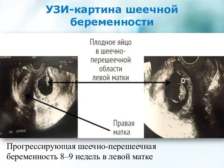 УЗИ-картина шеечной беременности Прогрессирующая шеечно-перешеечная беременность 8–9 недель в левой матке