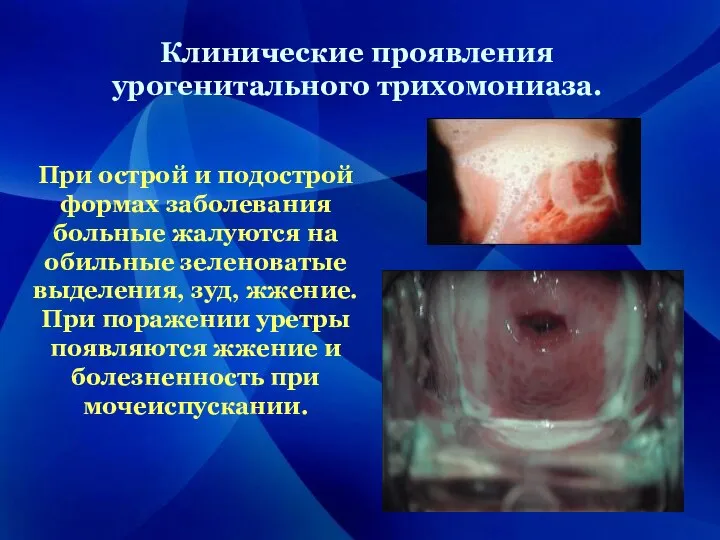 При острой и подострой формах заболевания больные жалуются на обильные зеленоватые выделения,