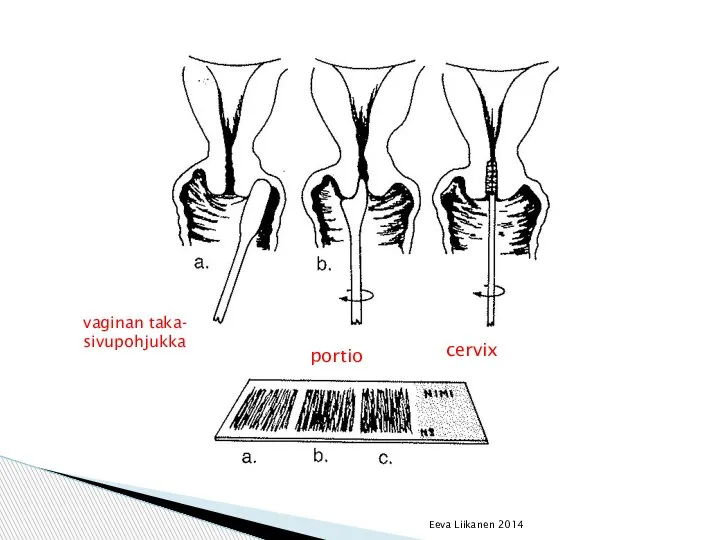Eeva Liikanen 2014 vaginan taka- sivupohjukka portio cervix