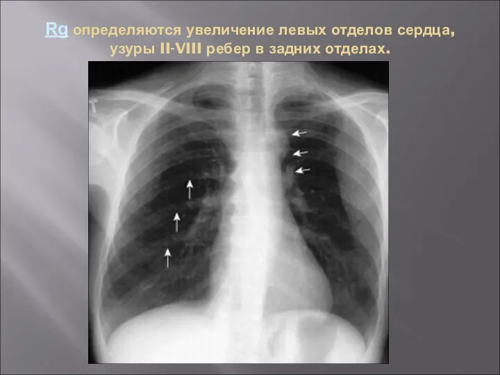 Rg определяются увеличение левых отделов сердца, узуры II-VIII ребер в задних отделах.