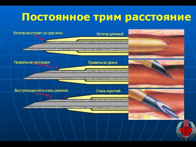 Постоянное трим расстояние