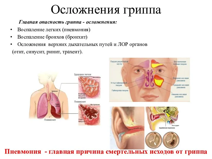 Осложнения гриппа Главная опасность гриппа - осложнения: Воспаление легких (пневмония) Воспаление бронхов