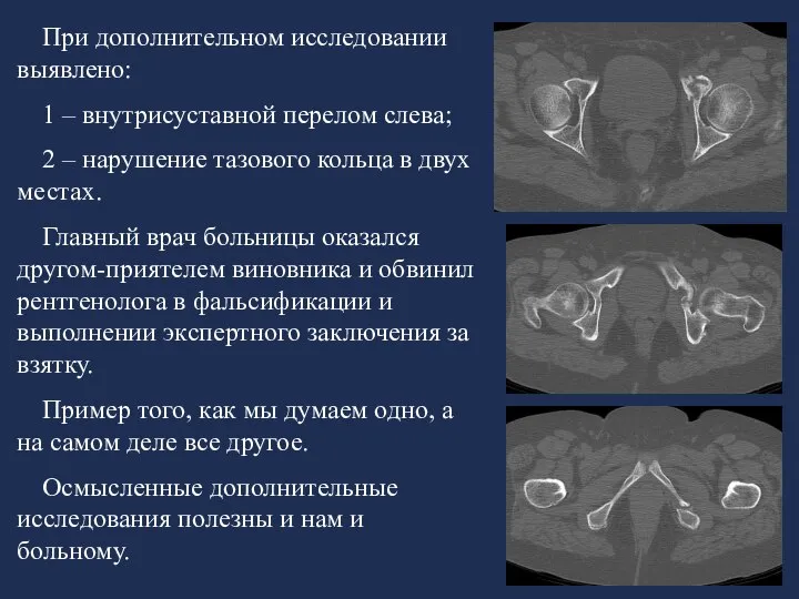 При дополнительном исследовании выявлено: 1 – внутрисуставной перелом слева; 2 – нарушение