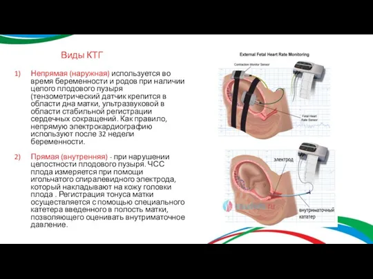 Виды КТГ Непрямая (наружная) используется во время беременности и родов при наличии