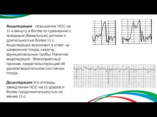 Акцелерации - повышение ЧСС на 15 в минуту и более по сравнению