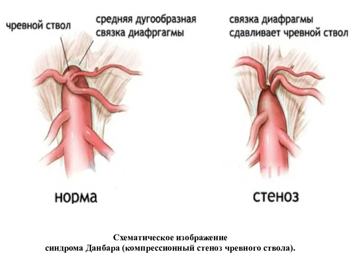 Схематическое изображение синдрома Данбара (компрессионный стеноз чревного ствола).