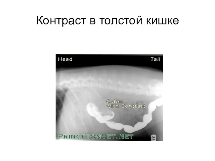 Контраст в толстой кишке