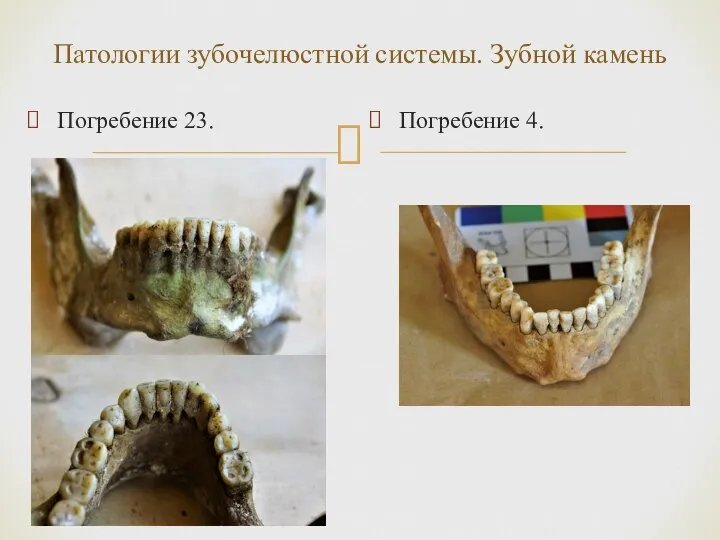 Патологии зубочелюстной системы. Зубной камень Погребение 23. Погребение 4.