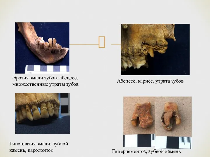 Эрозия эмали зубов, абсцесс, множественные утраты зубов Гипоплазия эмали, зубной камень, пародонтоз