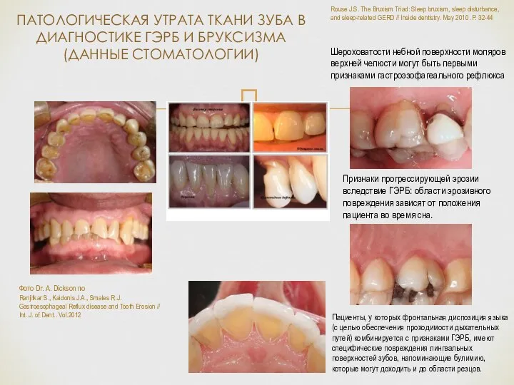 ПАТОЛОГИЧЕСКАЯ УТРАТА ТКАНИ ЗУБА В ДИАГНОСТИКЕ ГЭРБ И БРУКСИЗМА (ДАННЫЕ СТОМАТОЛОГИИ) Фото