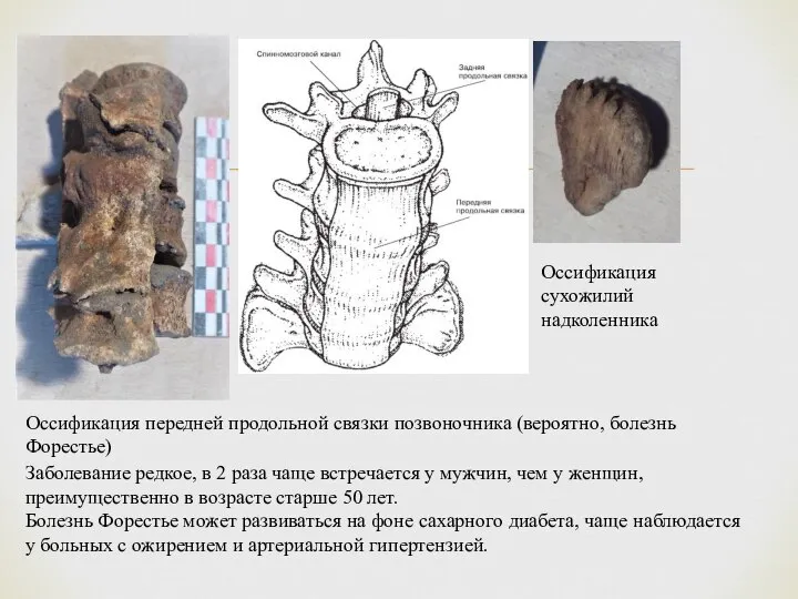 Оссификация передней продольной связки позвоночника (вероятно, болезнь Форестье) Оссификация сухожилий надколенника Заболевание