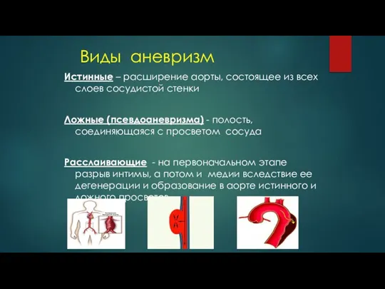 Виды аневризм Истинные – расширение аорты, состоящее из всех слоев сосудистой стенки