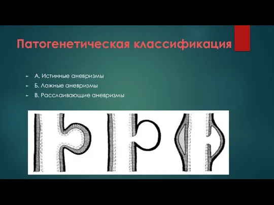 Патогенетическая классификация А. Истинные аневризмы Б. Ложные аневризмы В. Расслаивающие аневризмы