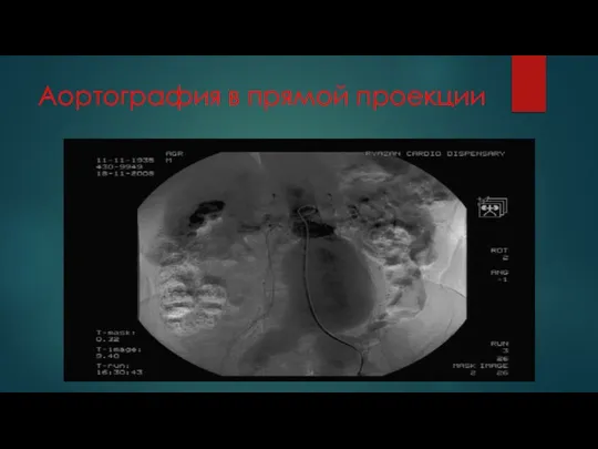 Аортография в прямой проекции