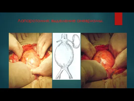 Лапаротомия: выделение аневризмы.