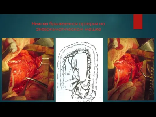 Нижняя брыжеечная артерия на аневризматическом мешке
