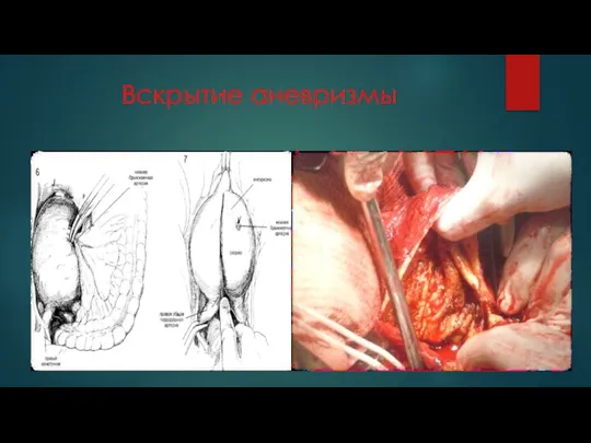 Вскрытие аневризмы