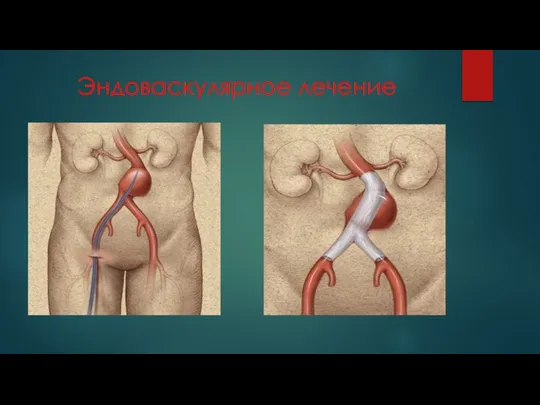 Эндоваскулярное лечение