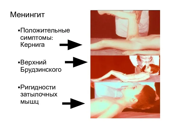 Менингит Положительные симптомы: Кернига Верхний Брудзинского Ригидности затылочных мышц