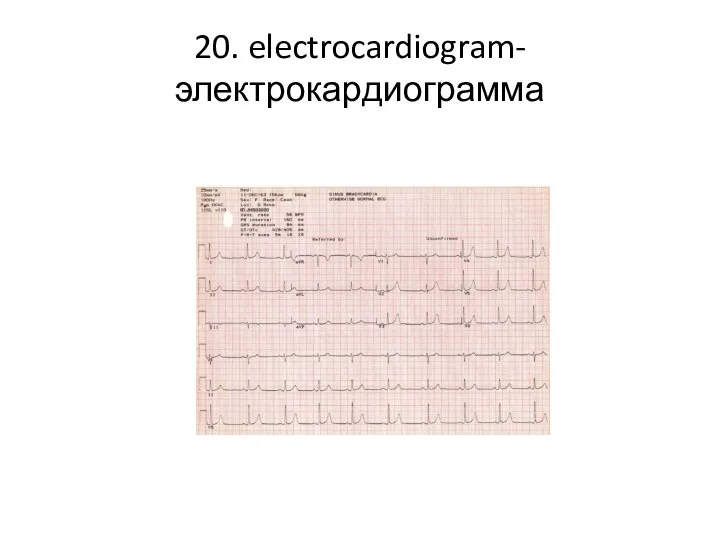 20. electrocardiogram-электрокардиограмма
