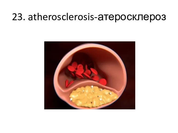 23. atherosclerosis-атеросклероз