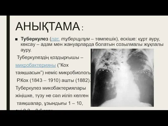 АНЫҚТАМА : Туберкулез (лат. тұберцұлұм – төмпешік), ескіше: құрт ауру, көксау –