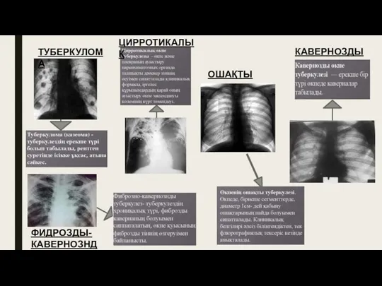 ТУБЕРКУЛОМА ФИДРОЗДЫ- КАВЕРНОЗНДЫ ЦИРРОТИКАЛЫҚ ОШАҚТЫ КАВЕРНОЗДЫ