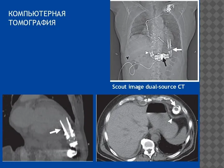 КОМПЬЮТЕРНАЯ ТОМОГРАФИЯ Scout image dual-source CT