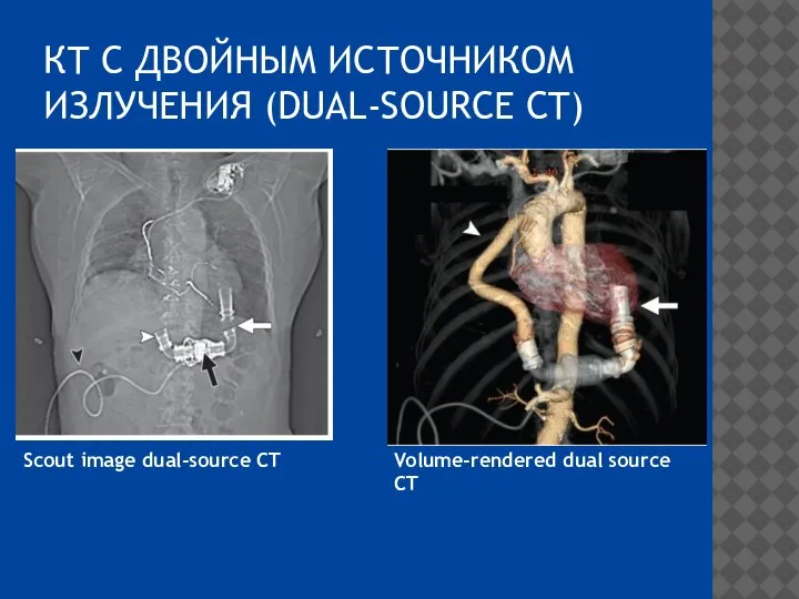 КТ С ДВОЙНЫМ ИСТОЧНИКОМ ИЗЛУЧЕНИЯ (DUAL-SOURCE CT) Scout image dual-source CT Volume-rendered dual source CT
