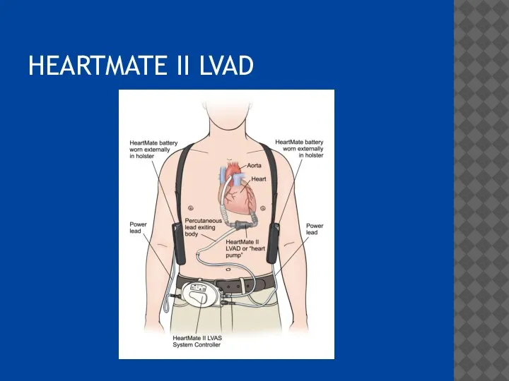 HEARTMATE II LVAD