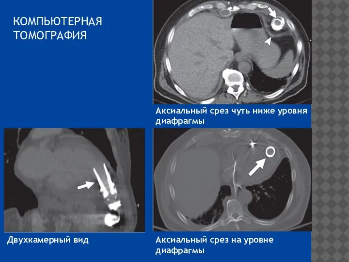 КОМПЬЮТЕРНАЯ ТОМОГРАФИЯ Аксиальный срез чуть ниже уровня диафрагмы Двухкамерный вид Аксиальный срез на уровне диафрагмы