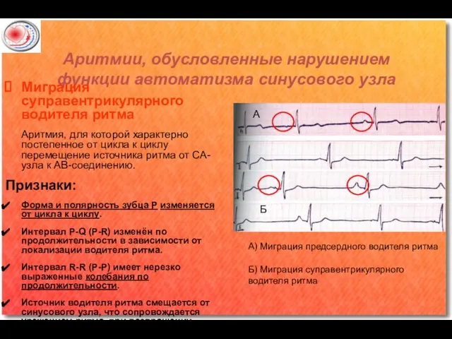 Аритмии, обусловленные нарушением функции автоматизма синусового узла Миграция суправентрикулярного водителя ритма Аритмия,