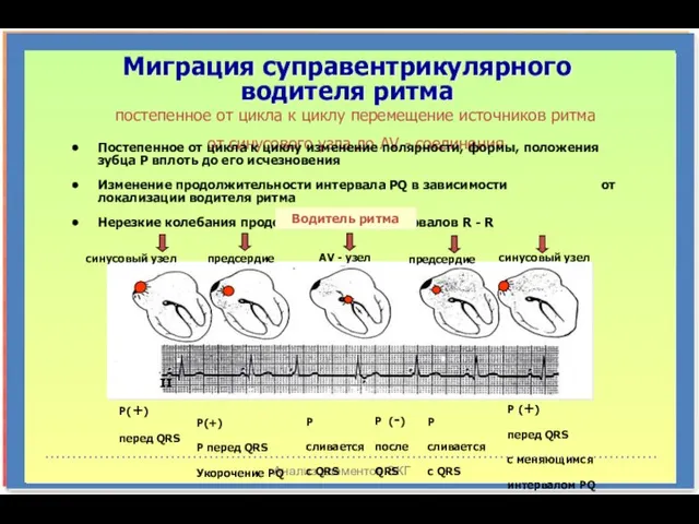 Анализ элементов ЭКГ Миграция суправентрикулярного водителя ритма постепенное от цикла к циклу