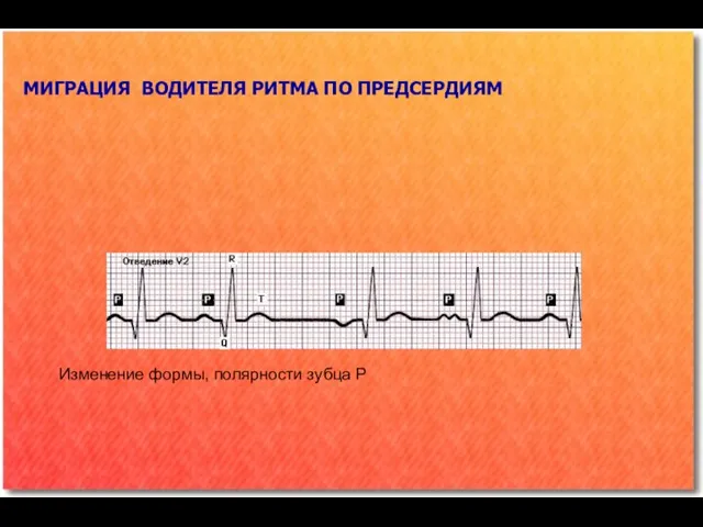 МИГРАЦИЯ ВОДИТЕЛЯ РИТМА ПО ПРЕДСЕРДИЯМ Изменение формы, полярности зубца Р