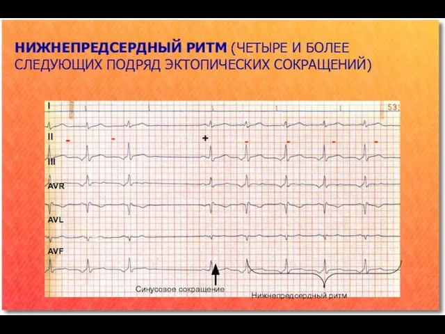 НИЖНЕПРЕДСЕРДНЫЙ РИТМ (ЧЕТЫРЕ И БОЛЕЕ СЛЕДУЮЩИХ ПОДРЯД ЭКТОПИЧЕСКИХ СОКРАЩЕНИЙ) I II III