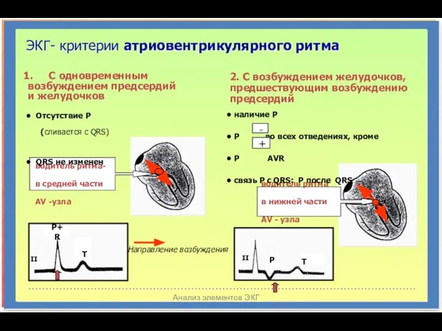 Анализ элементов ЭКГ ЭКГ- критерии атриовентрикулярного ритма С одновременным возбуждением предсердий и