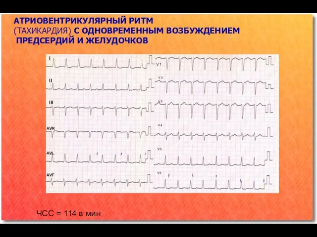 АТРИОВЕНТРИКУЛЯРНЫЙ РИТМ (ТАХИКАРДИЯ) С ОДНОВРЕМЕННЫМ ВОЗБУЖДЕНИЕМ ПРЕДСЕРДИЙ И ЖЕЛУДОЧКОВ ЧСС = 114