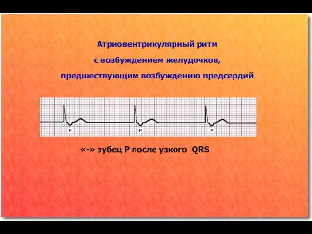 «-» зубец Р после узкого QRS Атриовентрикулярный ритм с возбуждением желудочков, предшествующим возбуждению предсердий