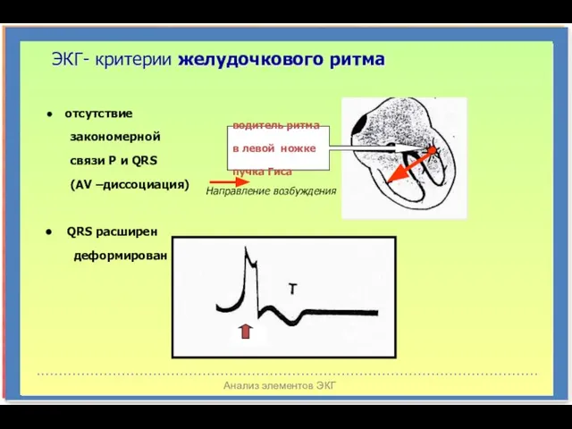 Анализ элементов ЭКГ ЭКГ- критерии желудочкового ритма водитель ритма в левой ножке